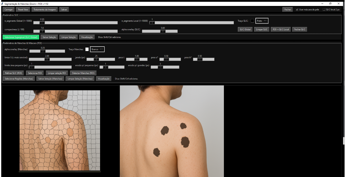 Detecção automática de manchas por inteligência artificial em imagem corporal